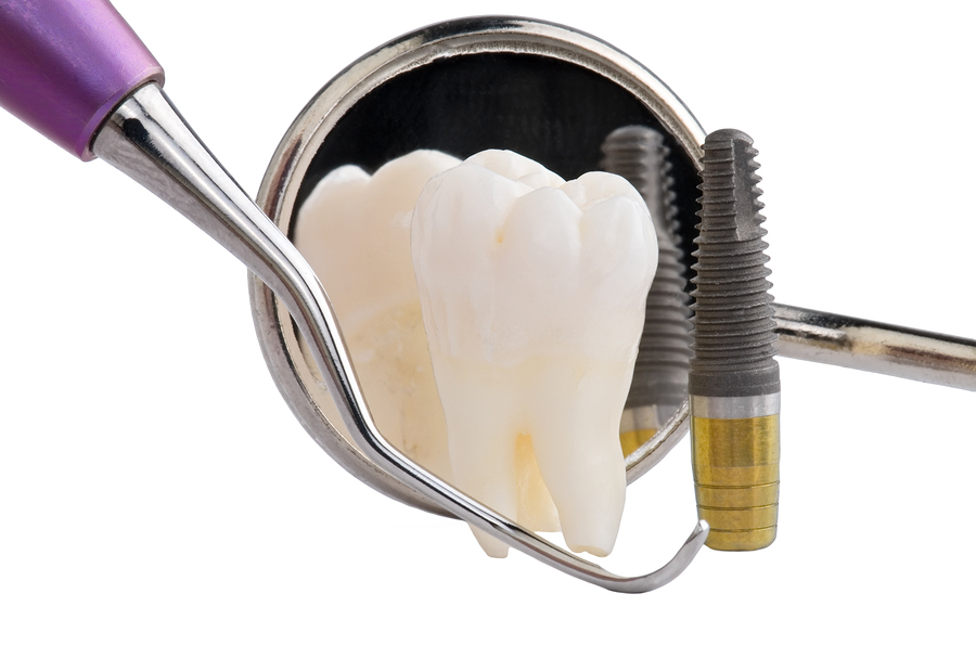 dental implants Alvin TX